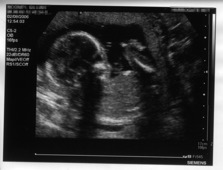 20 week scan